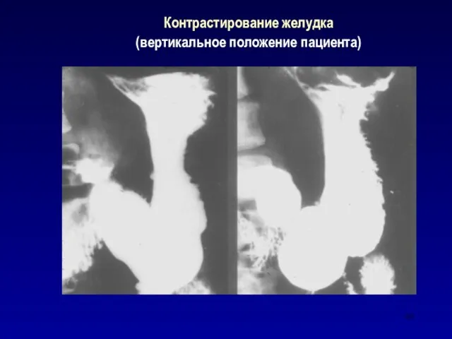 Контрастирование желудка (вертикальное положение пациента)