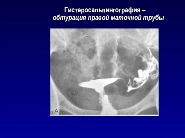 Гистеросальпингография – обтурация правой маточной трубы