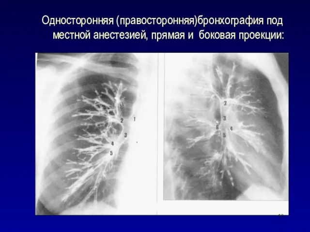 Односторонняя (правосторонняя)бронхография под местной анестезией, прямая и боковая проекции: