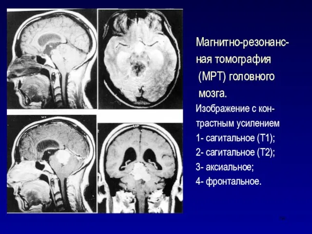 Магнитно-резонанс- ная томография (МРТ) головного мозга. Изображение с кон- трастным усилением 1-