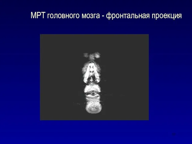 МРТ головного мозга - фронтальная проекция