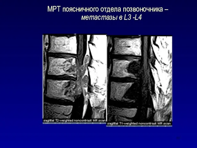 МРТ поясничного отдела позвоночника – метастазы в L3 -L4