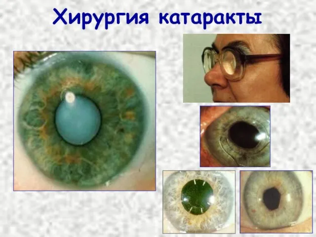 Хирургия катаракты