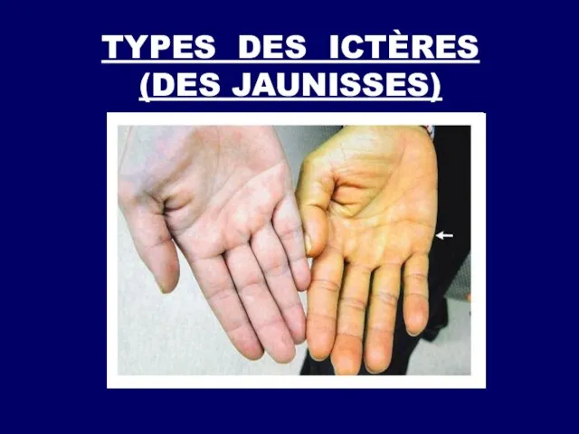 TYPES DES ICTÈRES (DES JAUNISSES)