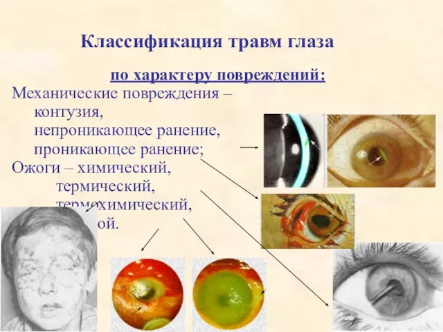Классификация травм глаза по характеру повреждений: Механические повреждения – контузия, непроникающее ранение,