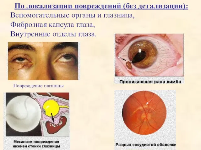 По локализации повреждений (без детализации): Вспомогательные органы и глазница, Фиброзная капсула глаза,
