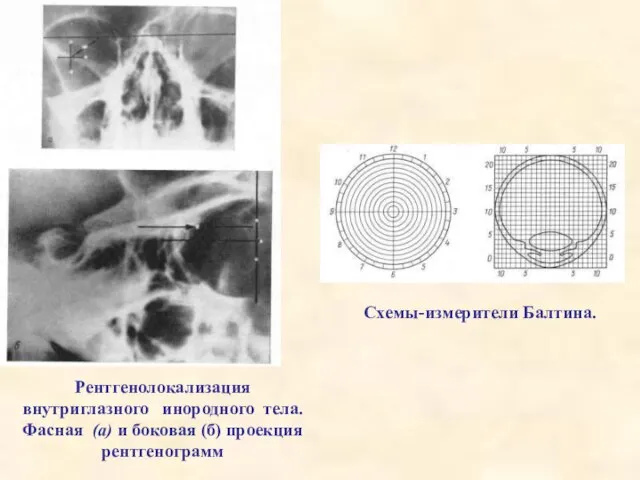 Рентгенолокализация внутриглазного инородного тела. Фасная (а) и боковая (б) проекция рентгенограмм Схемы-измерители Балтина.