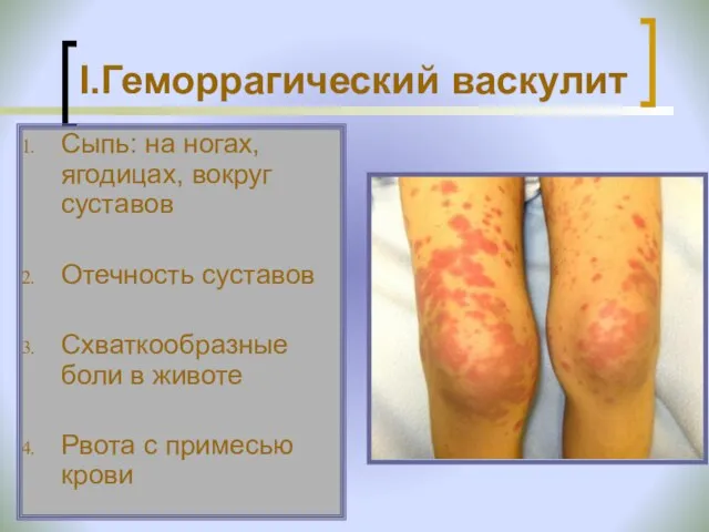 I.Геморрагический васкулит Сыпь: на ногах, ягодицах, вокруг суставов Отечность суставов Схваткообразные боли