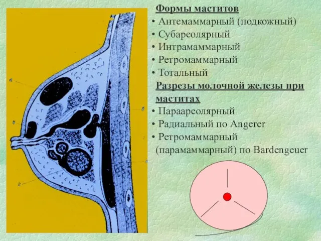 Формы маститов Антемаммарный (подкожный) Субареолярный Интрамаммарный Ретромаммарный Тотальный Разрезы молочной железы при