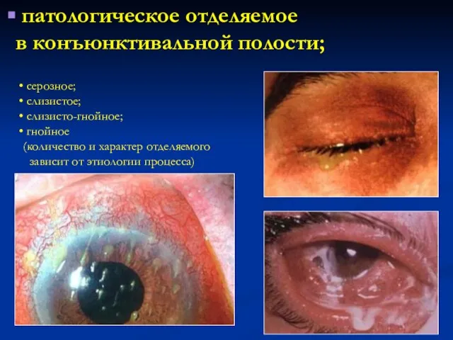 патологическое отделяемое в конъюнктивальной полости; серозное; слизистое; слизисто-гнойное; гнойное (количество и характер