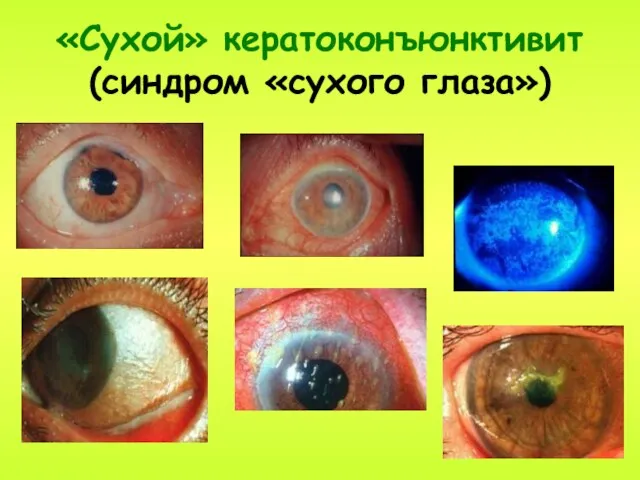 «Сухой» кератоконъюнктивит (синдром «сухого глаза»)