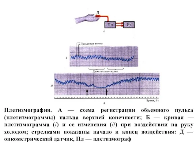 Плетизмография. А — схема регистрации объемного пульса (плетизмограммы) пальца верхней конечности; Б