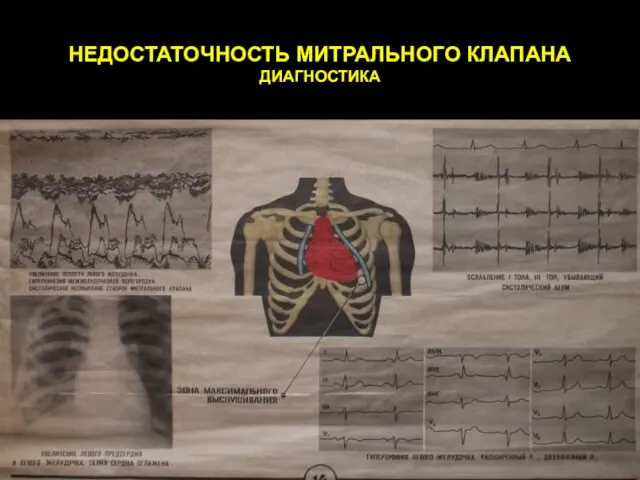 НЕДОСТАТОЧНОСТЬ МИТРАЛЬНОГО КЛАПАНА ДИАГНОСТИКА