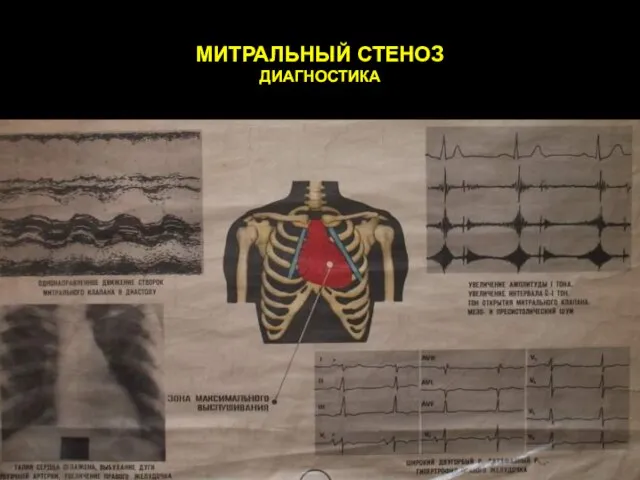 МИТРАЛЬНЫЙ СТЕНОЗ ДИАГНОСТИКА