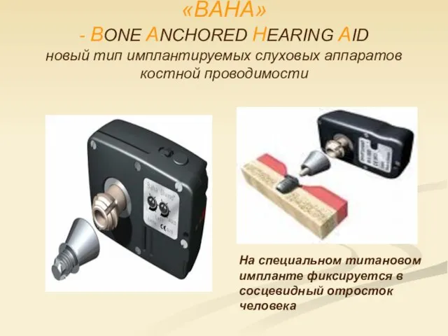 «BAHA» - ВОNЕ ANCHORED HEARING AID новый тип имплантируемых слуховых аппаратов костной