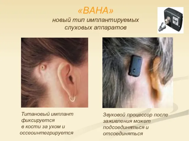 «BAHA» новый тип имплантируемых слуховых аппаратов Титановый имплант фиксируется в кости за