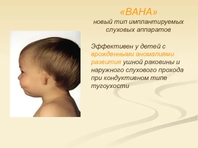 «BAHA» новый тип имплантируемых слуховых аппаратов Эффективен у детей с врожденными аномалиями