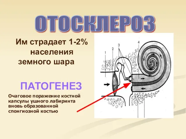 Им страдает 1-2% населения земного шара ОТОСКЛЕРОЗ ПАТОГЕНЕЗ Очаговое поражение костной капсулы