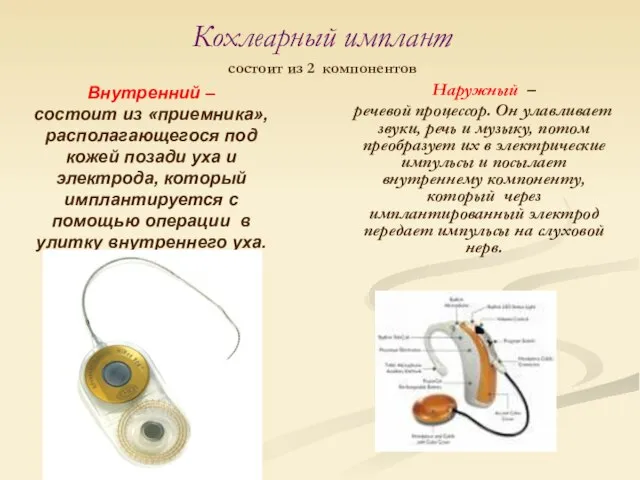 Наружный – речевой процессор. Он улавливает звуки, речь и музыку, потом преобразует