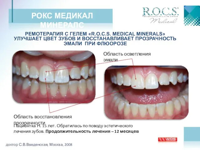 РОКС МЕДИКАЛ МИНЕРАЛС РЕМОТЕРАПИЯ С ГЕЛЕМ «R.O.C.S. MEDICAL MINERALS» УЛУЧШАЕТ ЦВЕТ ЗУБОВ