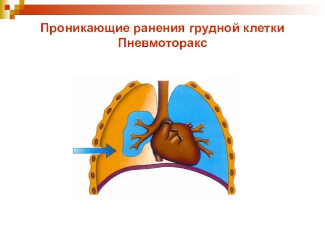 Проникающие ранения грудной клетки Пневмоторакс