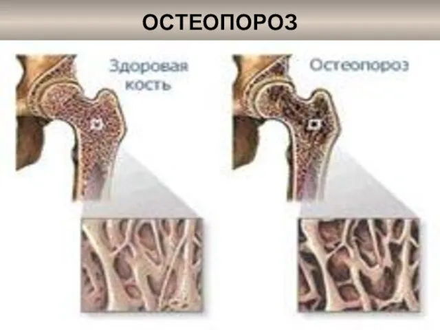 ОСТЕОПОРОЗ