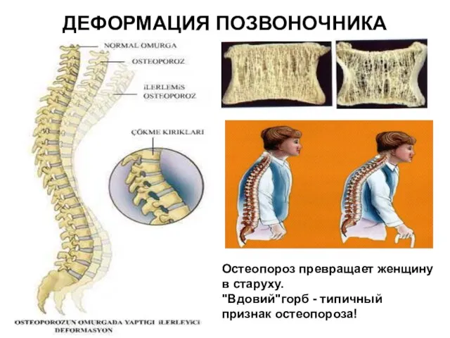 ДЕФОРМАЦИЯ ПОЗВОНОЧНИКА Остеопороз превращает женщину в старуху. "Вдовий"горб - типичный признак остеопороза!