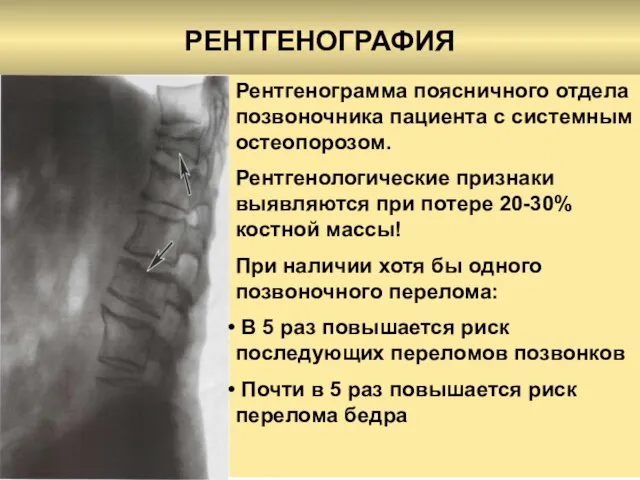 РЕНТГЕНОГРАФИЯ Рентгенограмма поясничного отдела позвоночника пациента с системным остеопорозом. Рентгенологические признаки выявляются