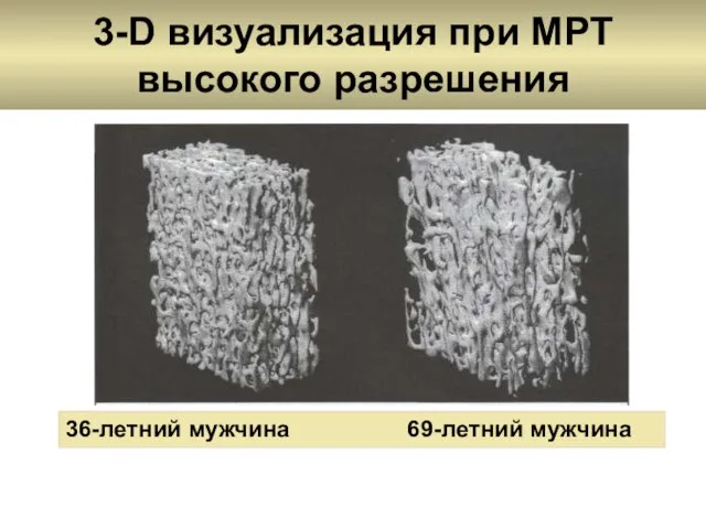 3-D визуализация при МРТ высокого разрешения 36-летний мужчина 69-летний мужчина