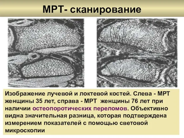 МРТ- сканирование Изображение лучевой и локтевой костей. Слева - МРТ женщины 35