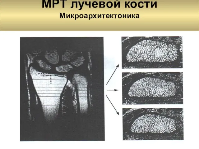 МРТ лучевой кости Микроархитектоника