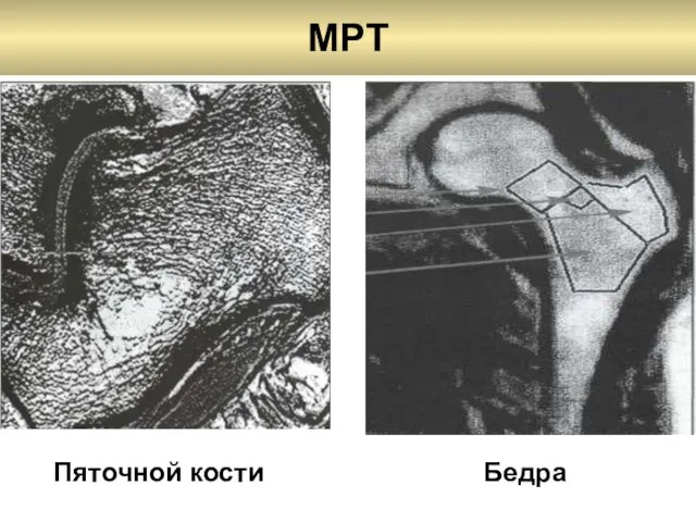 MPT Бедра Пяточной кости
