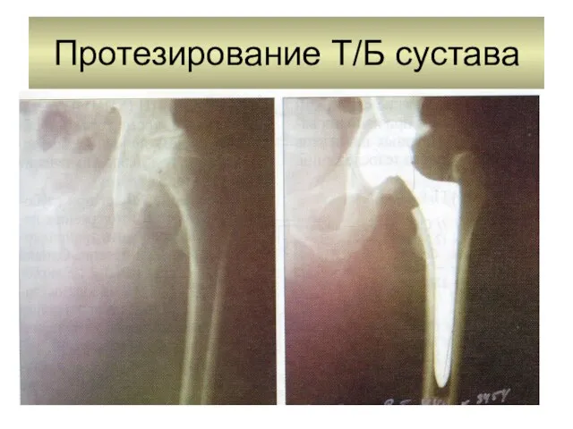 Протезирование Т/Б сустава