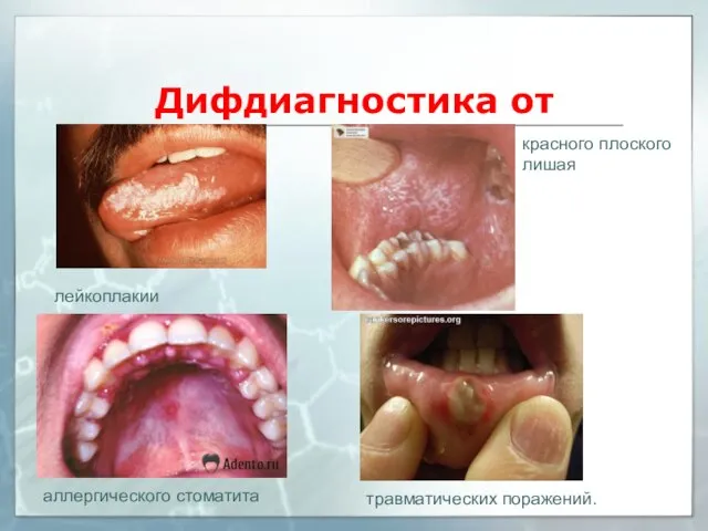 Дифдиагностика от лейкоплакии красного плоского лишая аллергического стоматита травматических поражений.