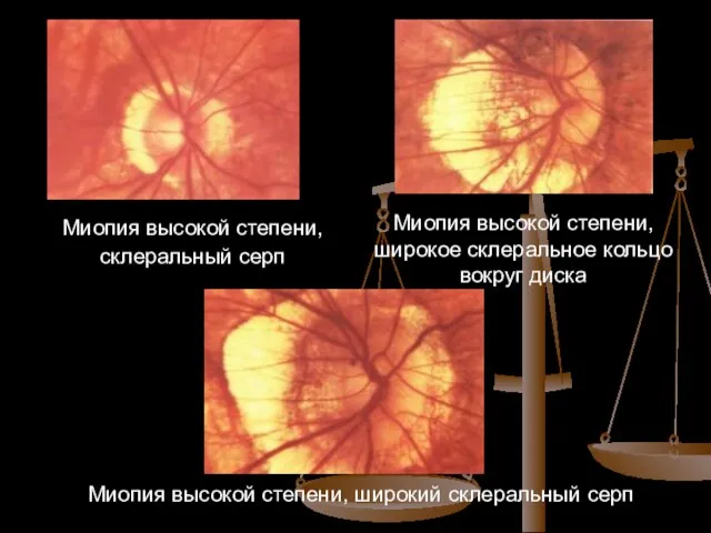 Миопия высокой степени, склеральный серп Миопия высокой степени, широкое склеральное кольцо вокруг