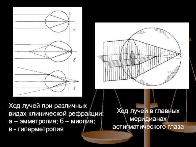 Ход лучей при различных видах клинической рефракции: а – эмметропия; б –