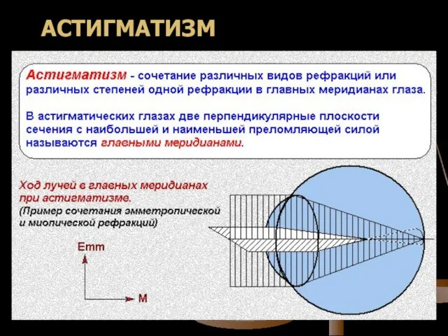 АСТИГМАТИЗМ