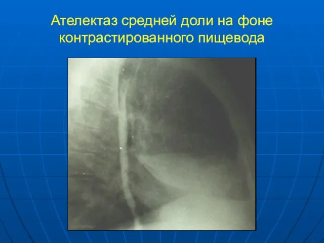 Ателектаз средней доли на фоне контрастированного пищевода