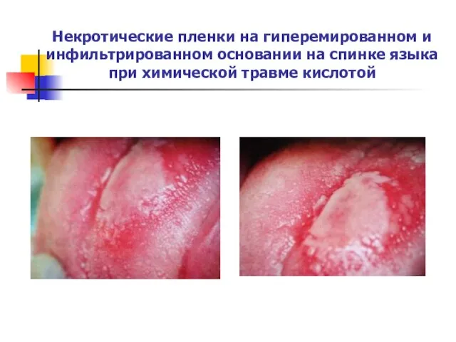 Некротические пленки на гиперемированном и инфильтрированном основании на спинке языка при химической травме кислотой