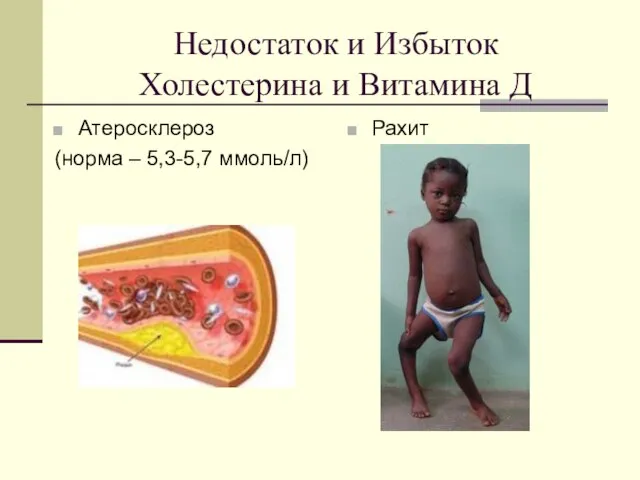 Недостаток и Избыток Холестерина и Витамина Д Атеросклероз (норма – 5,3-5,7 ммоль/л) Рахит