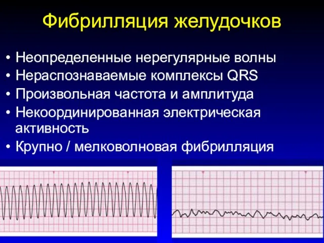 Фибрилляция желудочков Неопределенные нерегулярные волны Нераспознаваемые комплексы QRS Произвольная частота и амплитуда