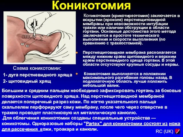 Коникотомия Схема коникотомии: 1- дуга перстневидного хряща 2- щитовидный хрящ Коникотомия (крикотиреотомия)