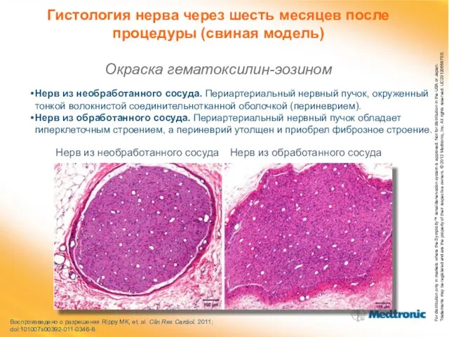 Гистология нерва через шесть месяцев после процедуры (свиная модель) Окраска гематоксилин-эозином Воспроизведено