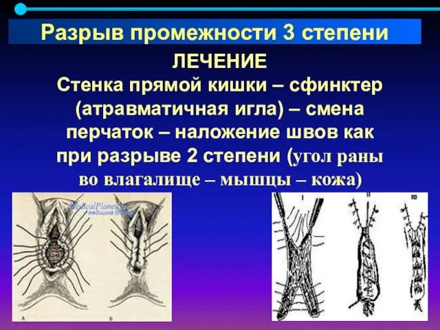 ЛЕЧЕНИЕ Стенка прямой кишки – сфинктер (атравматичная игла) – смена перчаток –