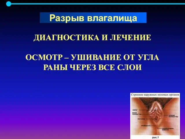 ДИАГНОСТИКА И ЛЕЧЕНИЕ ОСМОТР – УШИВАНИЕ ОТ УГЛА РАНЫ ЧЕРЕЗ ВСЕ СЛОИ Разрыв влагалища