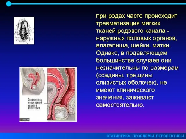 СТАТИСТИКА. ПРОБЛЕМЫ. ПЕРСПЕКТИВЫ При родах часто происходит травматизация мягких тканей родового канала