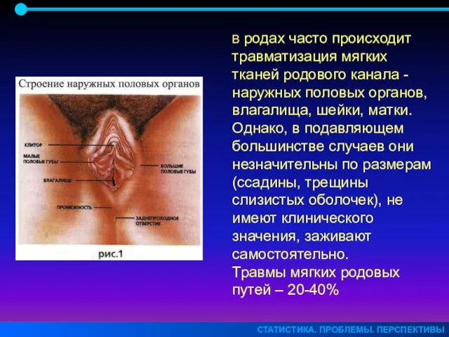 СТАТИСТИКА. ПРОБЛЕМЫ. ПЕРСПЕКТИВЫ В родах часто происходит травматизация мягких тканей родового канала