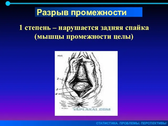 СТАТИСТИКА. ПРОБЛЕМЫ. ПЕРСПЕКТИВЫ 1 степень – нарушается задняя спайка (мышцы промежности целы) Разрыв промежности