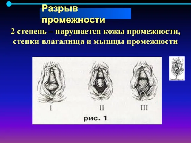 2 степень – нарушается кожы промежности, стенки влагалища и мышцы промежности Разрыв промежности