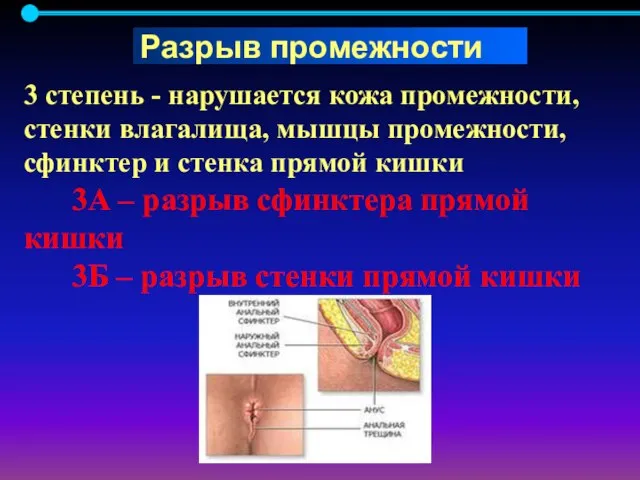 3 степень - нарушается кожа промежности, стенки влагалища, мышцы промежности, сфинктер и